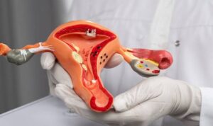 12,000 girls identified with cervical most cancers yearly – Minister